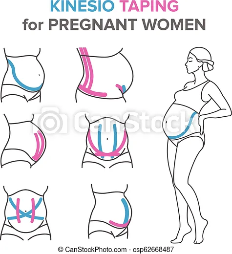 Kinesiology Tape For Pregnancy Helps Expecting Moms Get Their Shape Back：4 ways