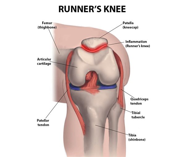 runner knee