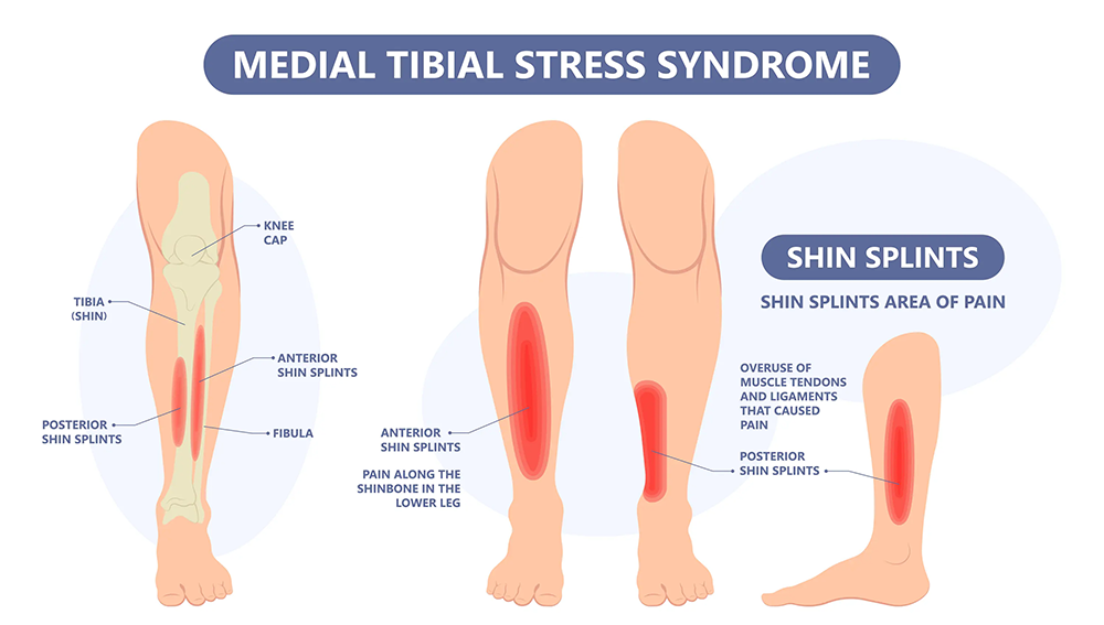 stecche della tibia