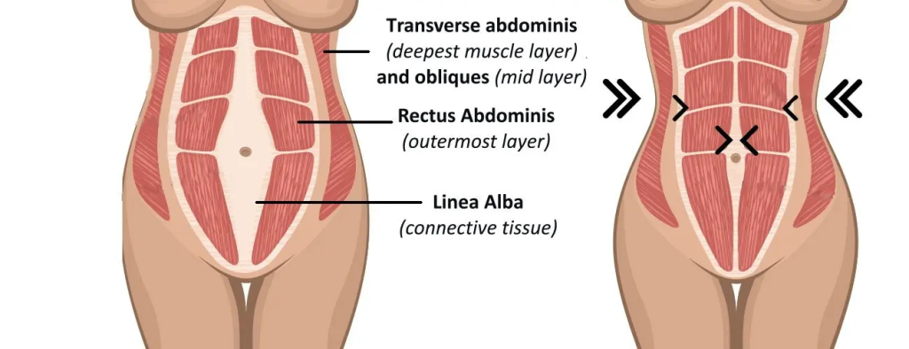 diastasis recti
