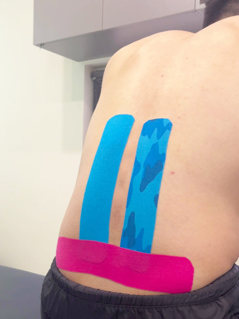 Kinesiologisches Tape für Si-Gelenk