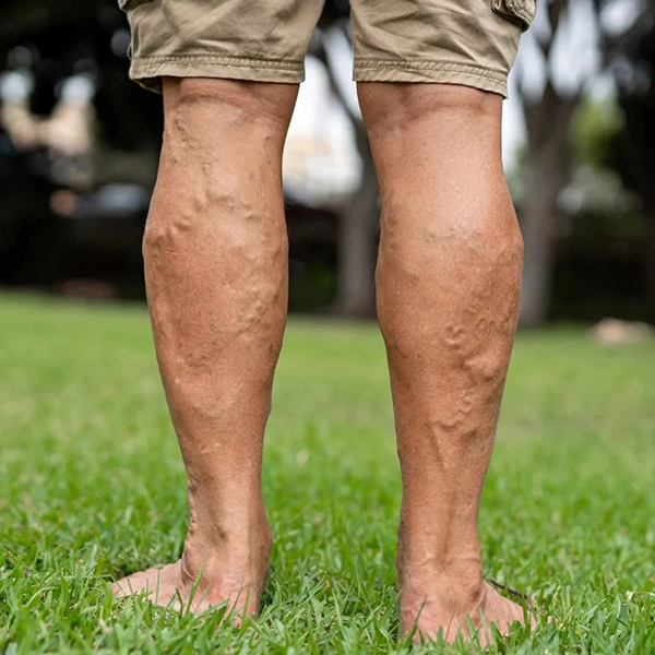 Varicose Veins