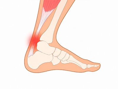 Achilles Tendonitis
