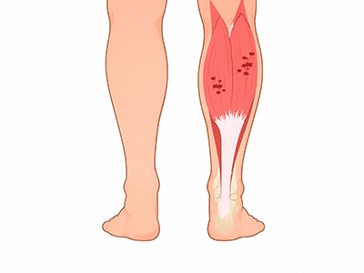 Calf Strains & Cramps