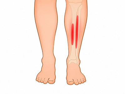 Shin Splints