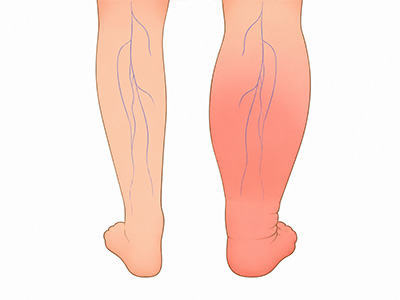 Swelling & Edema
