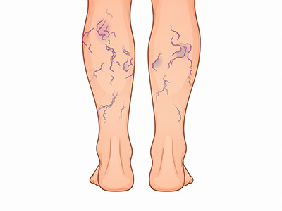 Varicose Veins