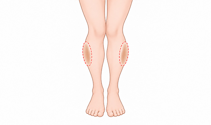 XO-Shaped Legs silicone calf pads